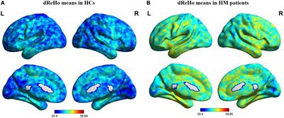 Exploration of abnormal dynamic spontaneous brain activity in patients with high myopia via dynamic regional homogeneity analysis